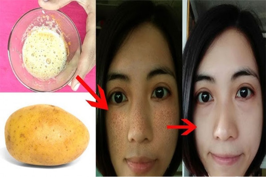 Potato Ras For Skin : क्या आलू का रस सच में डार्क स्किन को चमकदार बनाता है? इसके बारे में ये ज़रूरी बातें जानें!